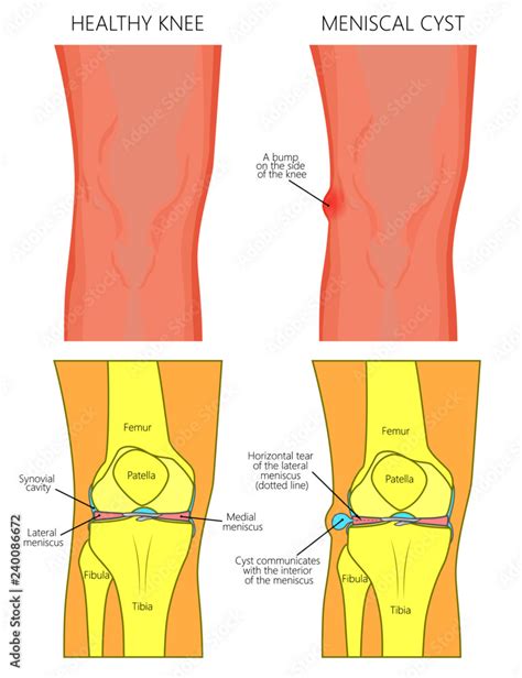 Vector illustration of a healthy human knee joint and unhealthy knee ...