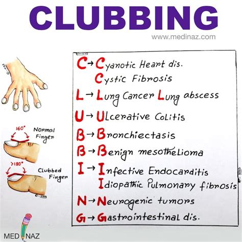 Nail Clubbing Causes & Mnemonic to Remember - Medinaz Blog