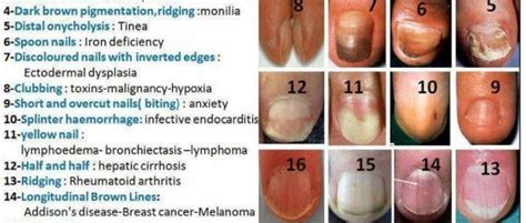 Nail ridges vitamin deficiency - Awesome Nail