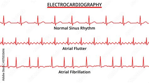 Ventricular Flutter Vs Fibrillation | The Best Porn Website