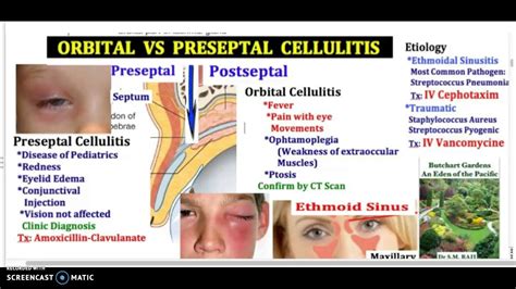 Cellulitis Anatomy