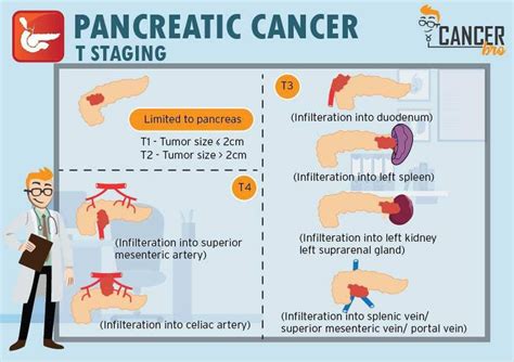 Pancreatic Cancer TNM Staging Explained [Videos Infographic] in Easy ...