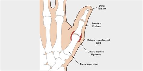 Sprained Thumb - The Complete Injury Guide - Vive Health