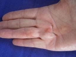 What does Dupuytren’s contracture look like? - Dupuytren Contracture ...