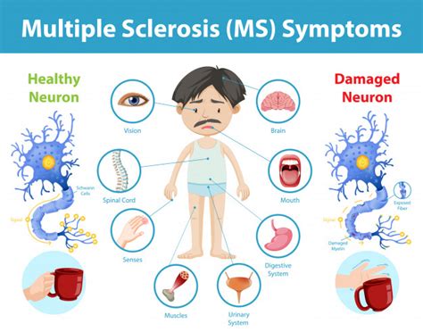 How does Multiple Sclerosis affect the Brain, Spinal cord, and Immune ...