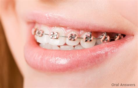 Why Braces Might Have Two Colored Rubber Bands Around Them | Oral Answers