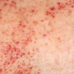 Treating Clients With Petechiae | ASCP Skin Care Professionals