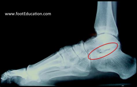 Subtalar Arthritis - FootEducation