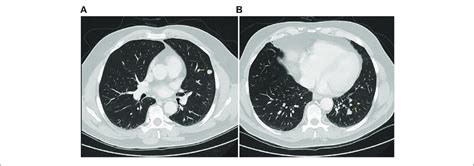 | CT scan showing left lung metastases (A,B). | Download Scientific Diagram