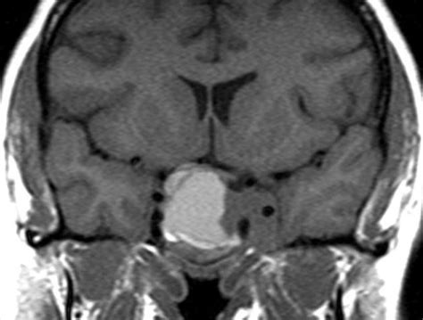 Normal Pituitary Mri