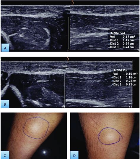 Lipoma Ultrasound Treatment - Infoupdate.org