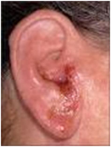 Denoc HearingOuter Ear & Diseases Related To It