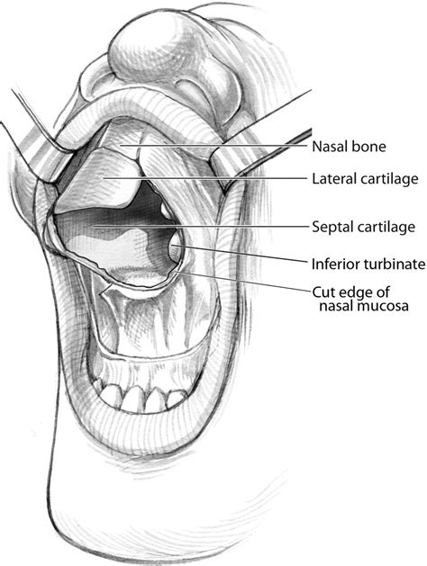 Facial degloving approach to the midface - Operative Techniques in ...