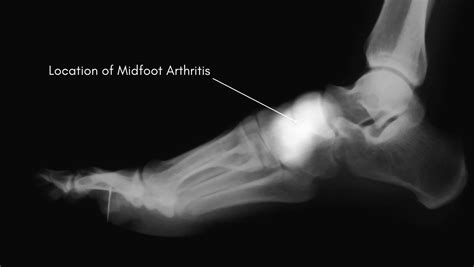 Midfoot Arthritis: Symptoms & Treatment by a Physical Therapist