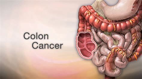 HIE Multimedia - Understanding your colorectal cancer risk