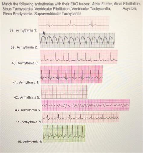 Solved Match the following arrhythmias with their EKG | Chegg.com