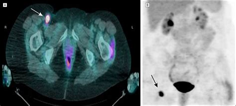 Paraneoplastic Optic Neuropathy From Cutaneous Melanoma Detected by ...