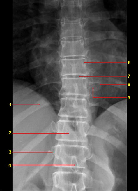 Thoracic Spine Radiographic Anatomy Wikiradiography | Images and Photos ...