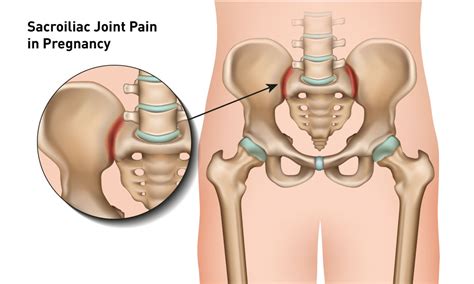 Sacroiliac during Pregnancy Symptoms, Causes, Symptoms, Treatment | QI ...