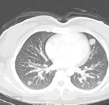 Last lung CT scan signifying progressive lung metastases. | Download ...