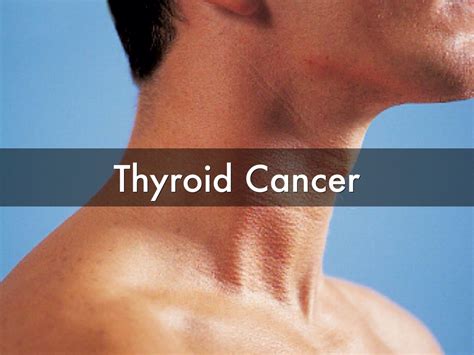 Increasing Incidence Of Thyroid Cancer In The United | Autos Post