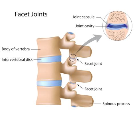 Facet Hypertrophy Symptoms, Diagnosis, Treatment | AllSpine