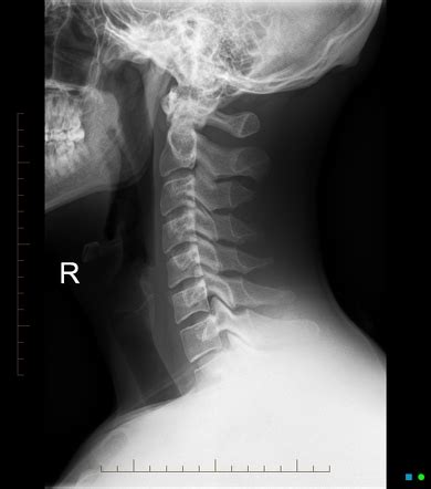 Normal cervical spine radiographs | Radiology Case | Radiopaedia.org