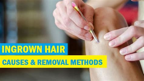 What Is Ingrown Hair? Causes and Safe Removal Methods - Tips and Beauty