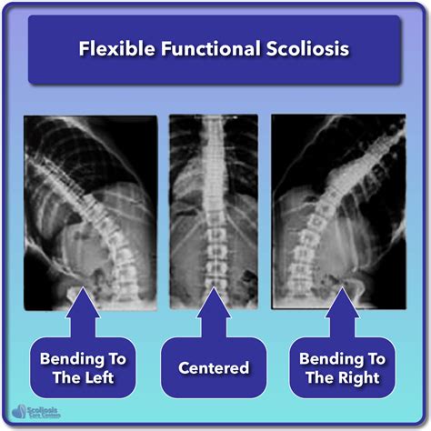 Functional Scoliosis