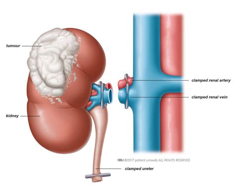 Radical nephrectomy - Patient Information