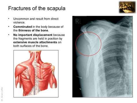 Imaging anatomy fracture of the scapula