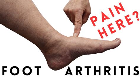 Foot Arthritis Pain: Most Common Signs and Symptoms - YouTube