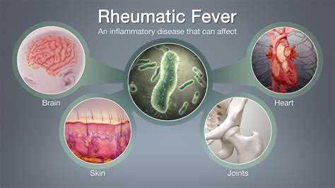 Rheumatic Fever | 470 plays | Quizizz