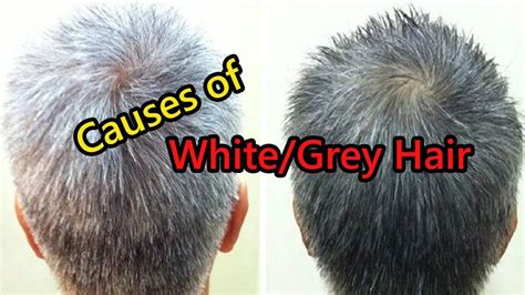 White Hairs At 20 : White Hair Causes And Ways To Prevent It - nippleop