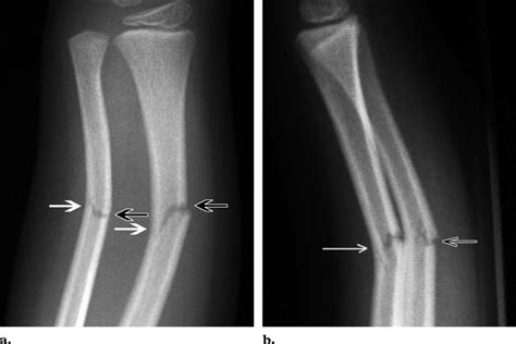 Greenstick Fracture X Ray