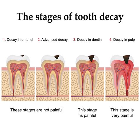 Stages of Tooth Decay | Dental in Rigby | Cedar Creek Dental