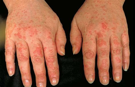 Rheumatoid Arthritis Skin Issues: Hives, Rashes, & More