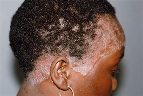 Scalp Psoriasis And Natural Hair – Natural Sisters – South African Hair ...