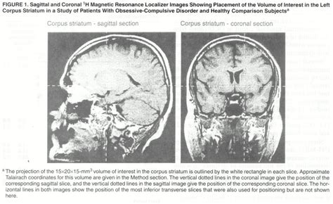 A Short Echo 1H Spectroscopy and Volumetric MRI Study of the Corpus ...