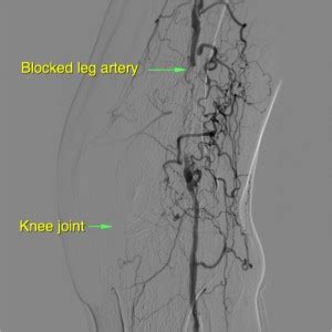 Angioplasty and Stent Insertion of Leg Arteries – Sydney Medical ...