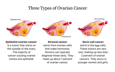 Unraveling Invasive Epithelial Ovarian Cancer – Coach M Morris