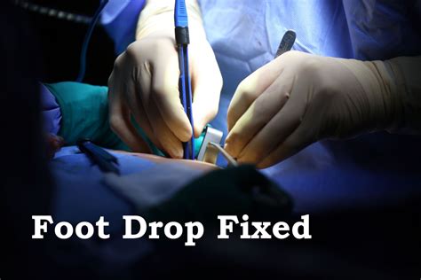 Foot Drop Surgically FIxed by Releasing Common Peroneal Nerve