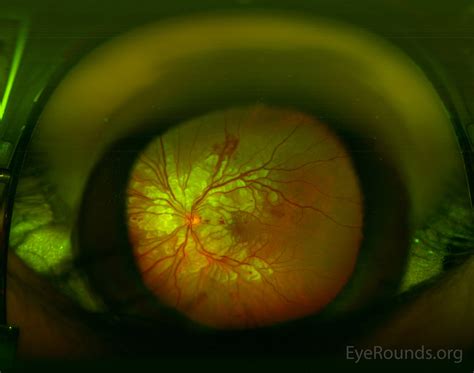 Purtscher Retinopathy