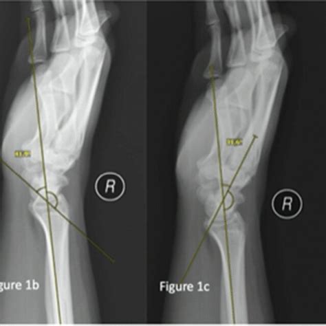 a Lateral scapholunate angle, b lateral radio-scaphoid angle, c lateral ...