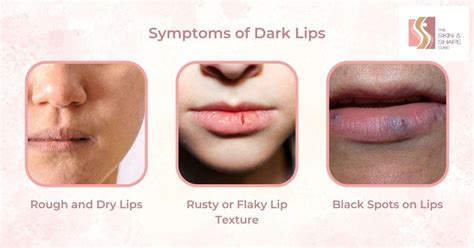 Dark Lips Treatment by Dermatologist - The Skin & Shape