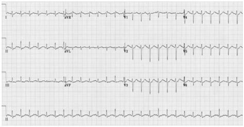 Sinus Tachycardia – Hope For Hearts