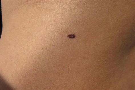 light brown moles appearing | Americanwarmoms.org