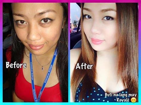 Glutathione Before And After Pictures - New Product Review articles ...