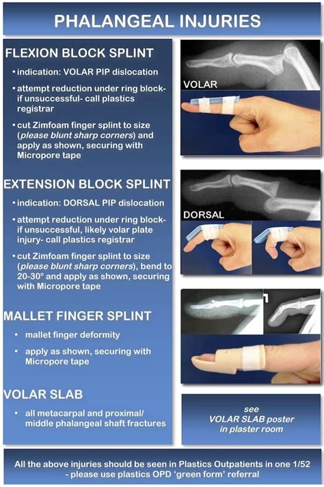 Proximal Phalanx Fracture Splint