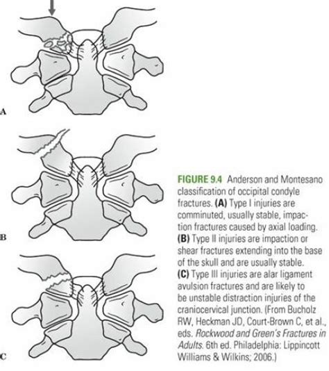 Occipital Condyle Fractures - RayOrthos